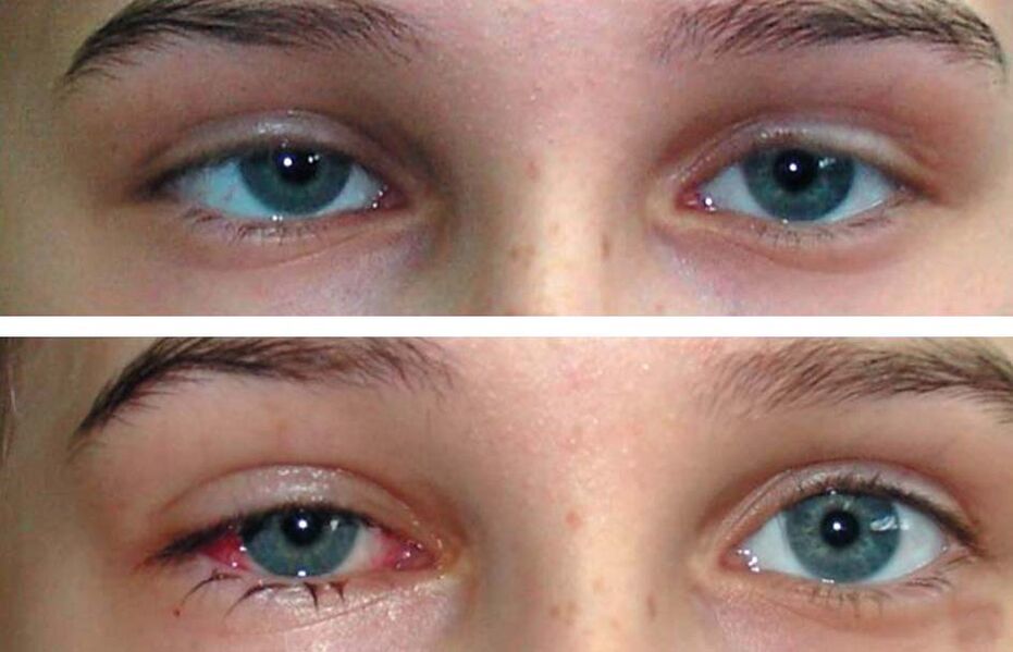 Antes e despois do tratamento Oculax